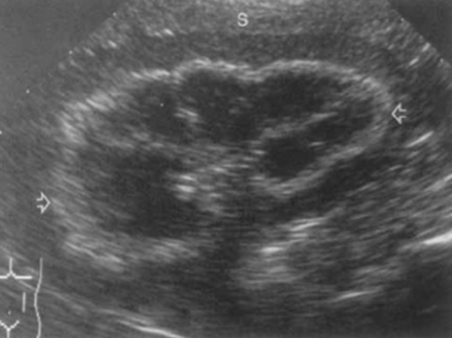 Sinal de medular na ultrassonografia renal