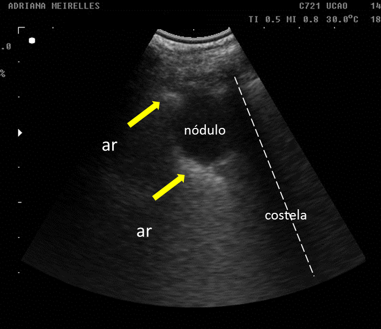 Ultrassonografia E N dulos Pulmonares