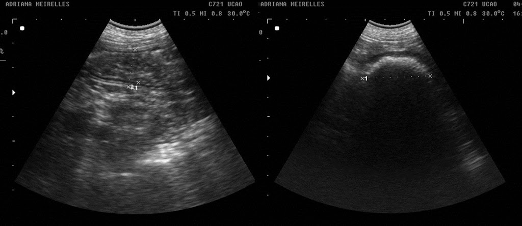 Ultrassonografia e obstrução intestinal